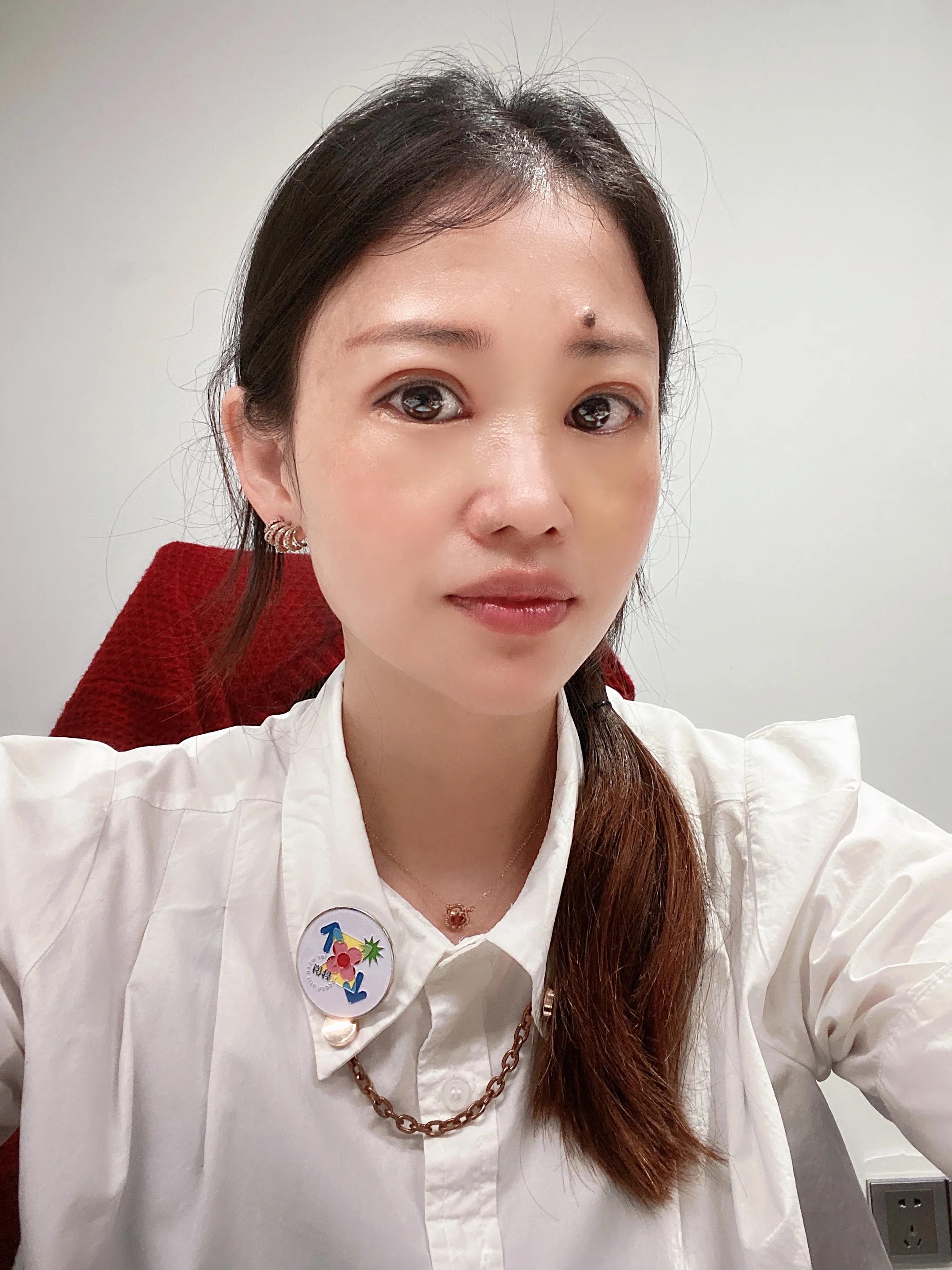 做双眼皮恢复期间能吃红糖吗,恢复最快的双眼皮