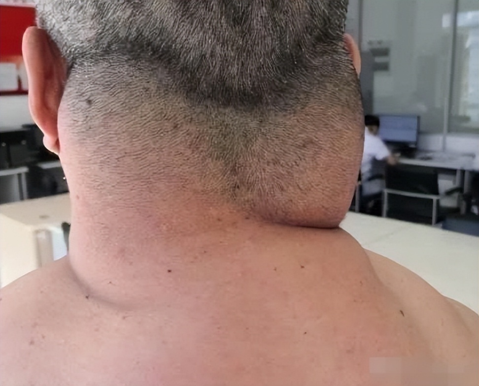 辽宁男子喝3万斤酒撑大脖子,男子嗜酒如命一天三四斤白酒