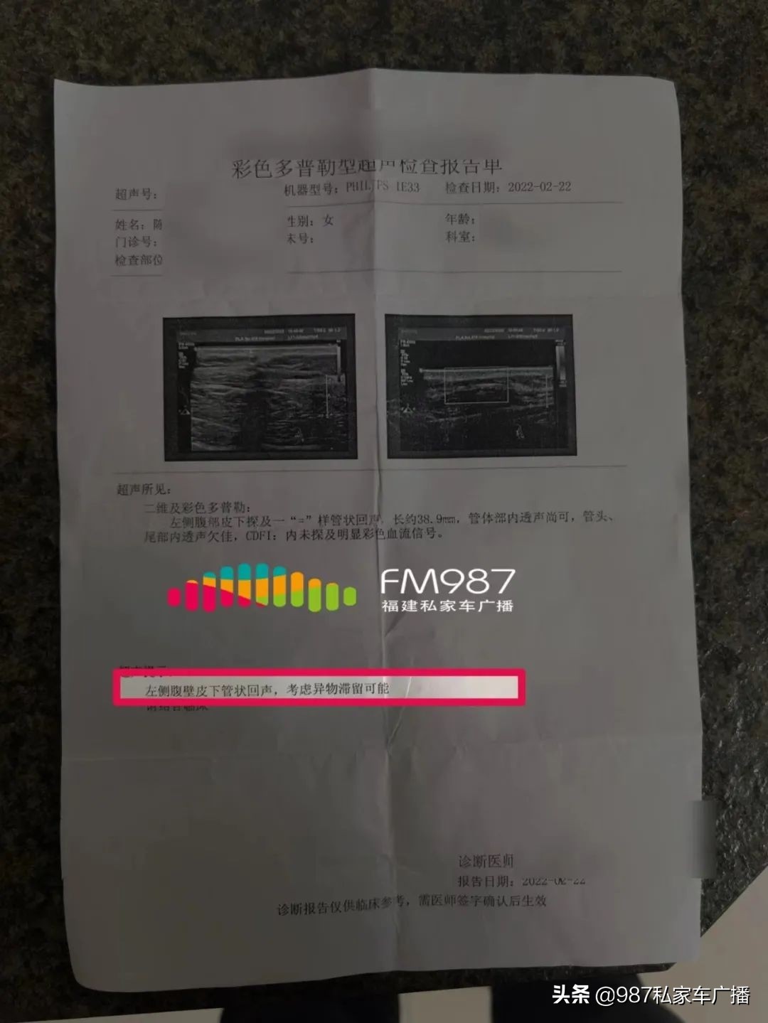 福州一女子体内取出大肿瘤,女子术后体内遗留3块纱布