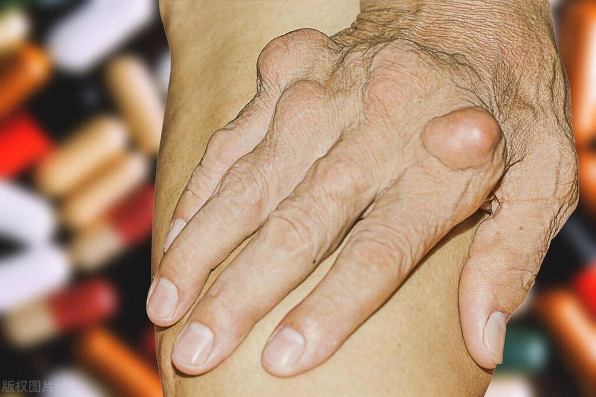 年轻女孩子得类风湿怎么办,预防老年类风湿性关节炎良方妙法