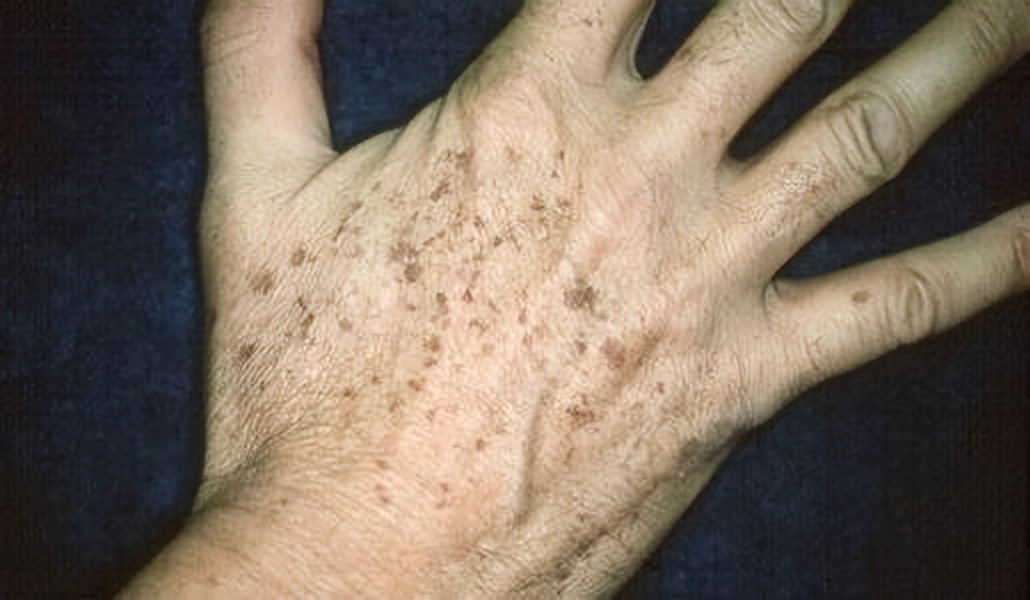 红霉素软膏可以去除老年斑吗,治疗脸上老年斑涂抹什么药膏