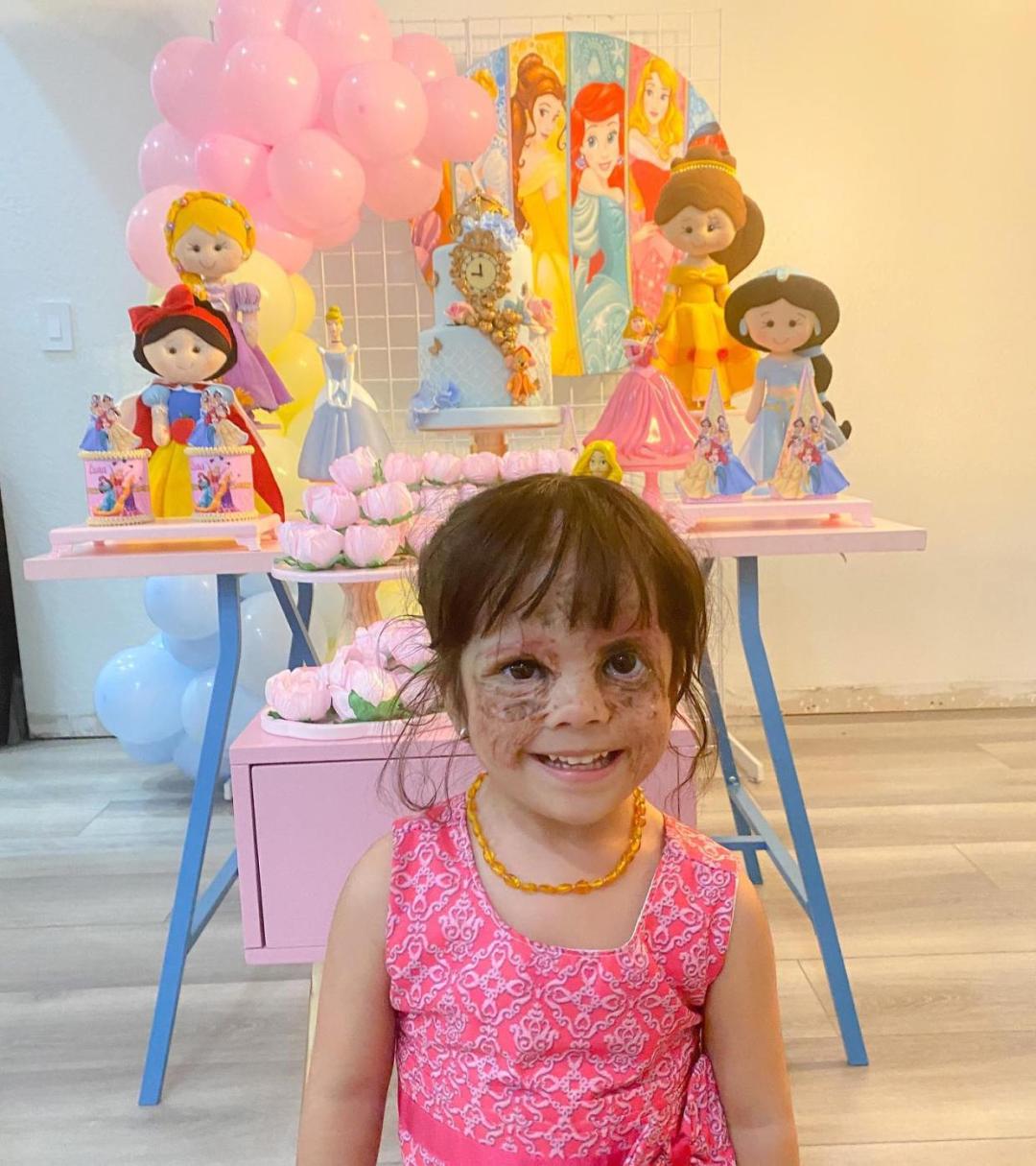 美国小女孩脸带“蝙蝠侠”黑印,治疗两年经过终于恢复肉色!