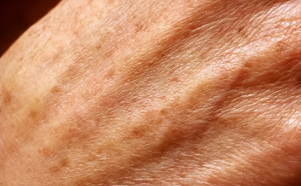 祛老年斑涂抹什么药膏有效,快速消除老年斑的小妙招红霉素