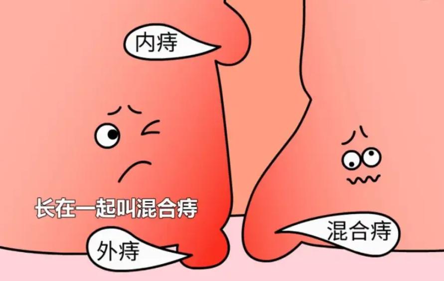 做痔疮手术换药全部流程,第二次痔疮手术后15天亲身经历