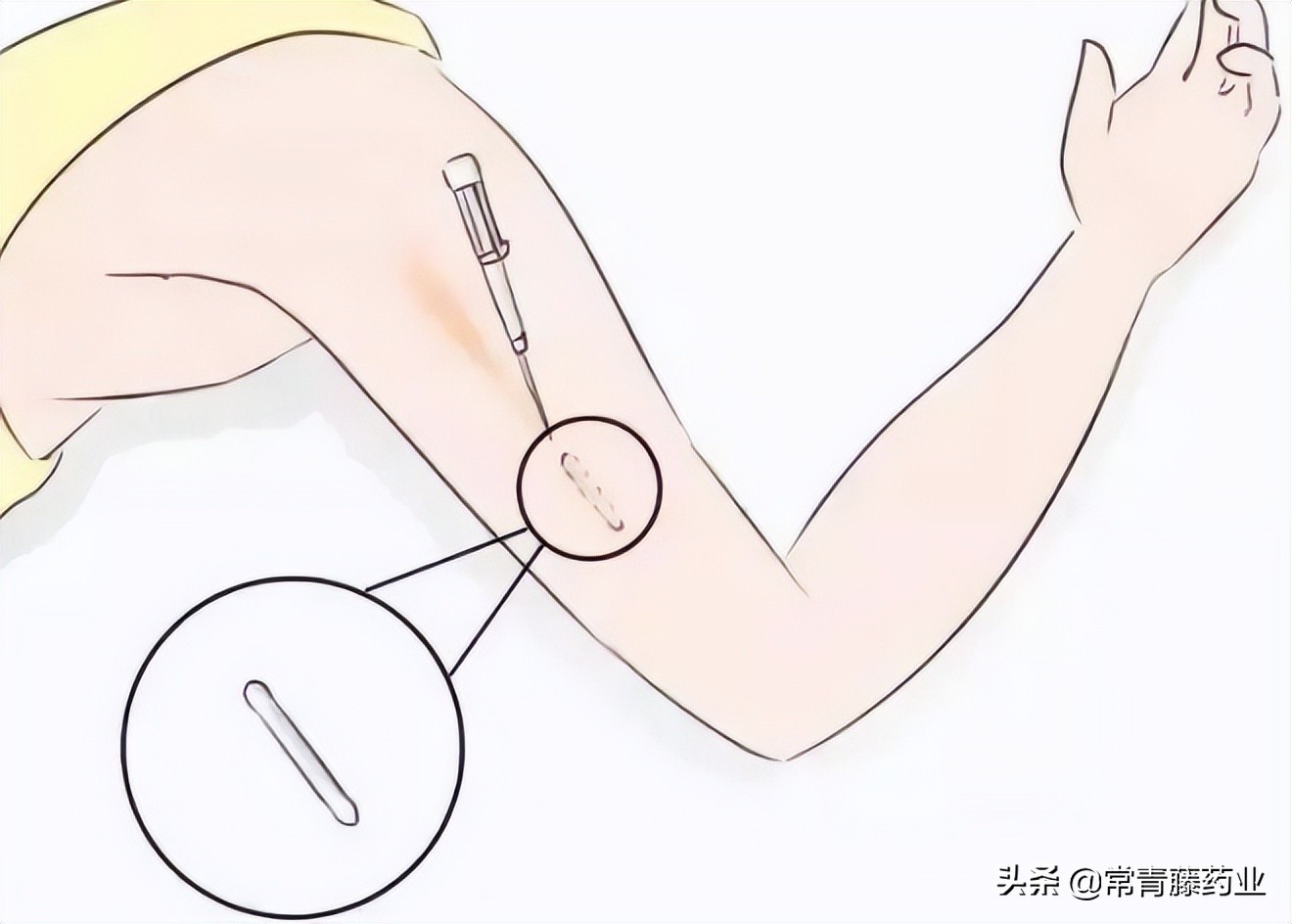 皮埋避孕的优点和缺点是什么,皮埋避孕所有人都能做吗