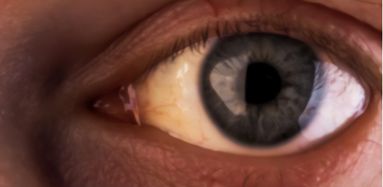 眼睛的白眼球有点黄是怎么回事,眼睛白眼球上有个红点怎么回事