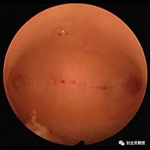 妇科专家教你认识宫腔镜,宫腔镜妇科主任