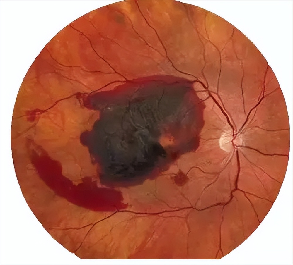 近视600度和700度的差别,600度近视和400度近视差别大吗