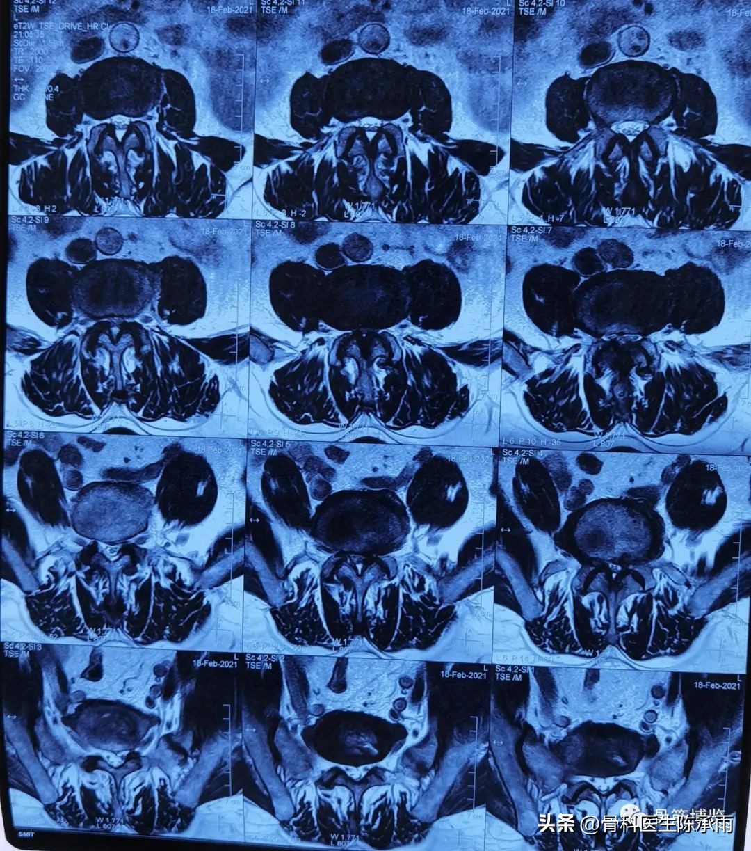 腰椎滑脱椎管狭窄手术后遗症,腰椎间盘突出椎管狭窄的手术