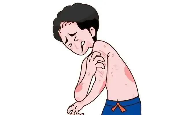 复方青黛片能治银屑病吗,复方青黛丸治疗银屑病疗效怎样