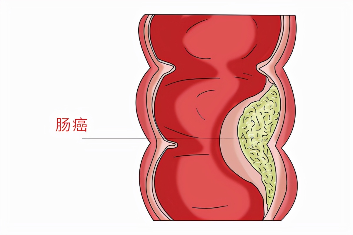 女性肛周瘙痒是癌吗,肛周瘙痒是直肠癌吗