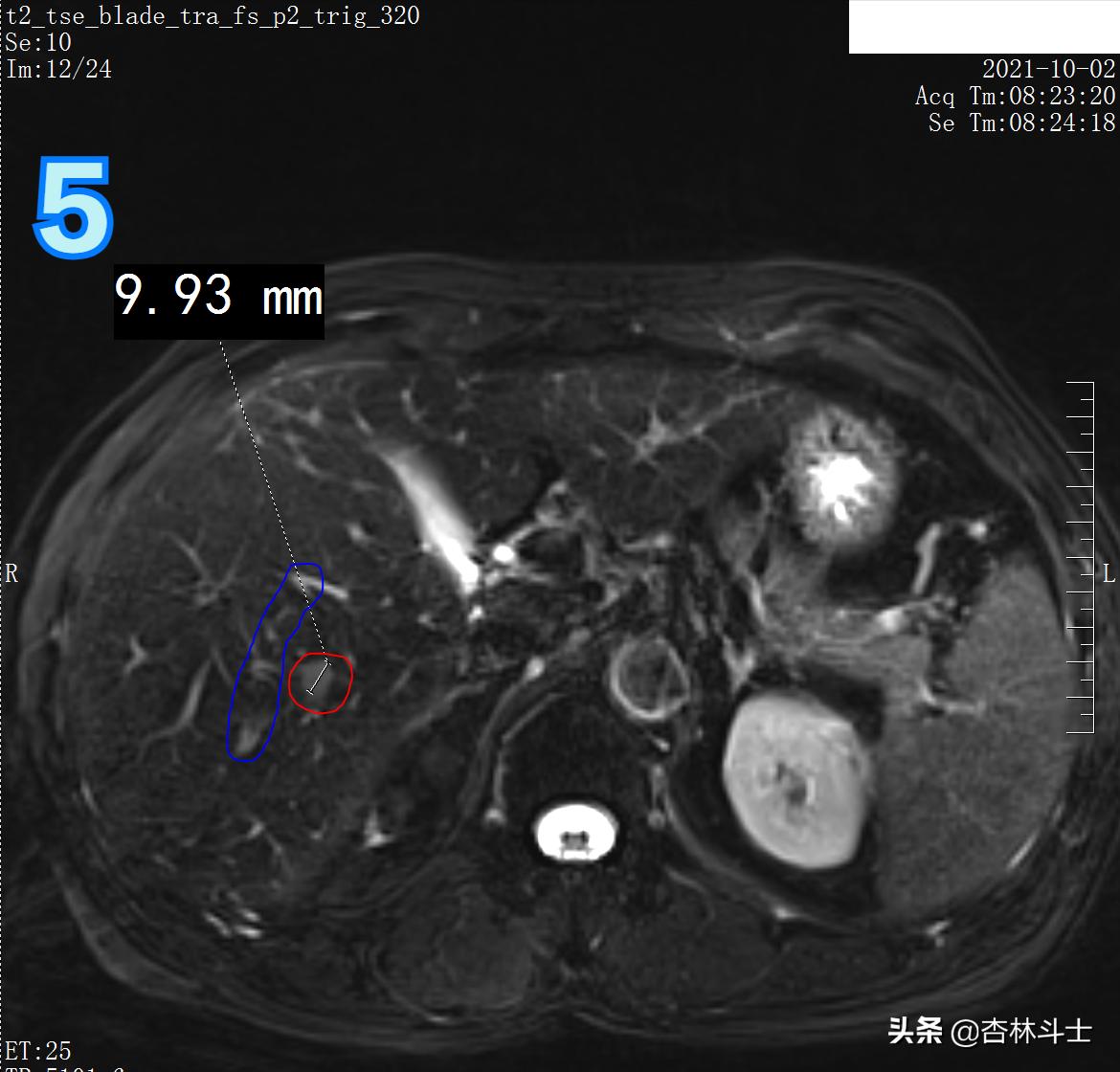 肝癌8公分肿瘤能活多久,肝癌细胞最大长多大