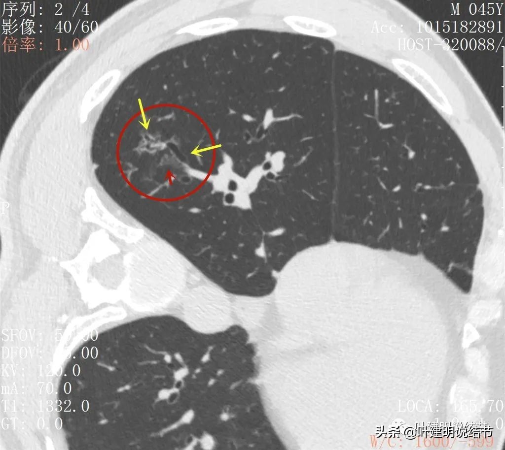肺蜂窝状改变是肺癌吗,肺部陈旧灶与肿瘤怎么确诊