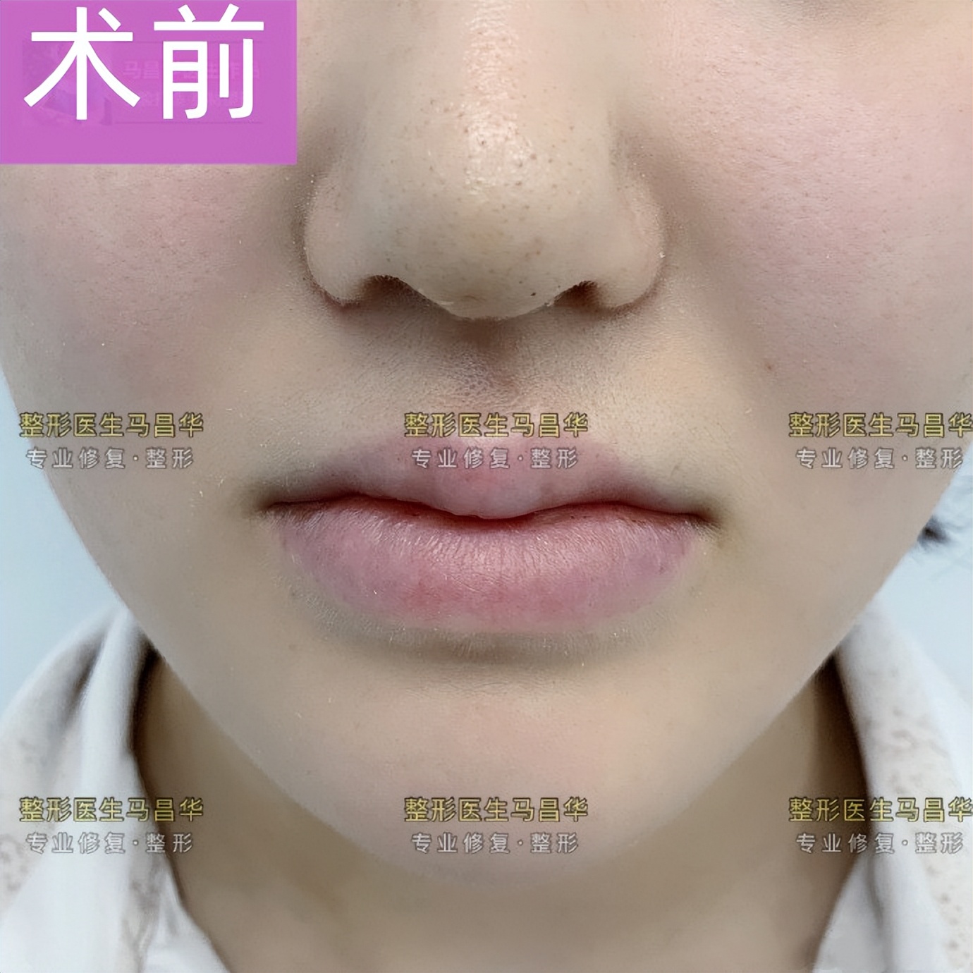 法令纹最好有效的去除方法,有法令纹最好的解决办法真实有效