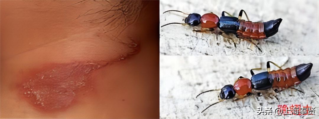 夏天虫咬皮炎的治疗方法,虫咬性皮炎到底如何杀虫