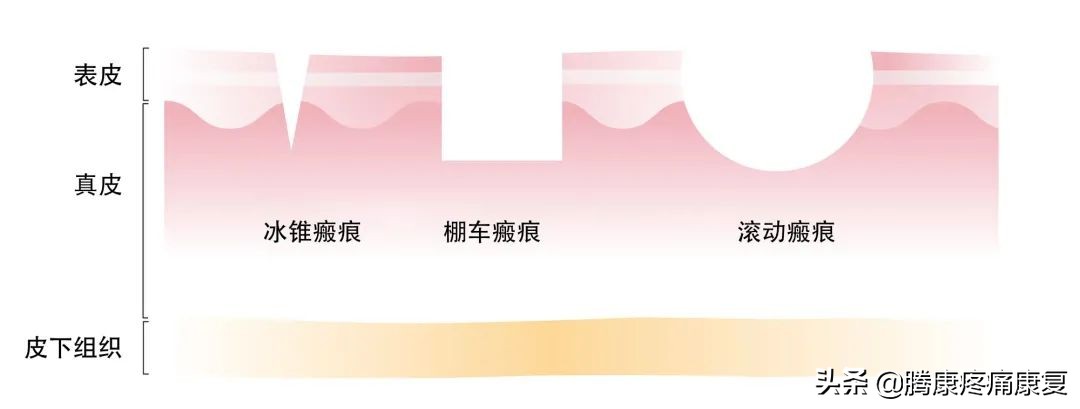 *疮痤**瘢痕的康复治疗