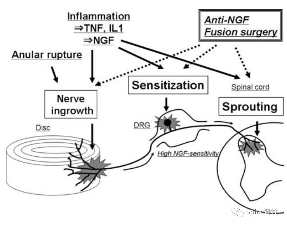 因腰椎问题导致的腰痛,慢性腰骶部疼痛