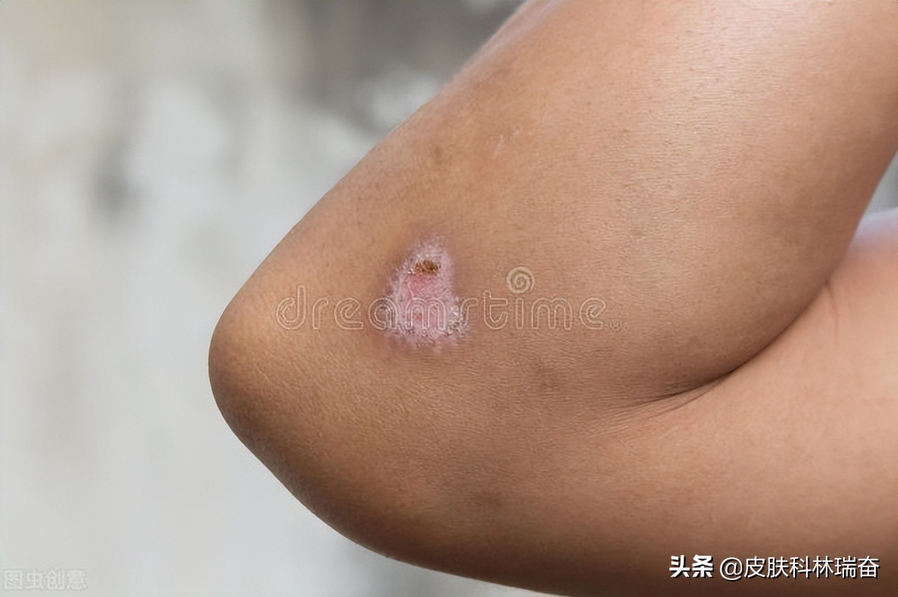 酱油影响疤痕愈合颜色吗,酱油是否会使皮肤留疤