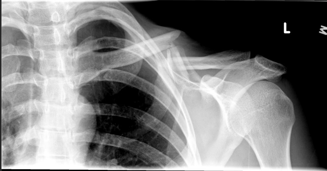 锁骨骨折吃什么食物最好,锁骨骨折怎么绑绷带视频