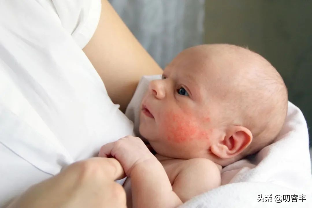 湿疹过敏忌口的食物一览表,婴幼儿湿疹和过敏的区别