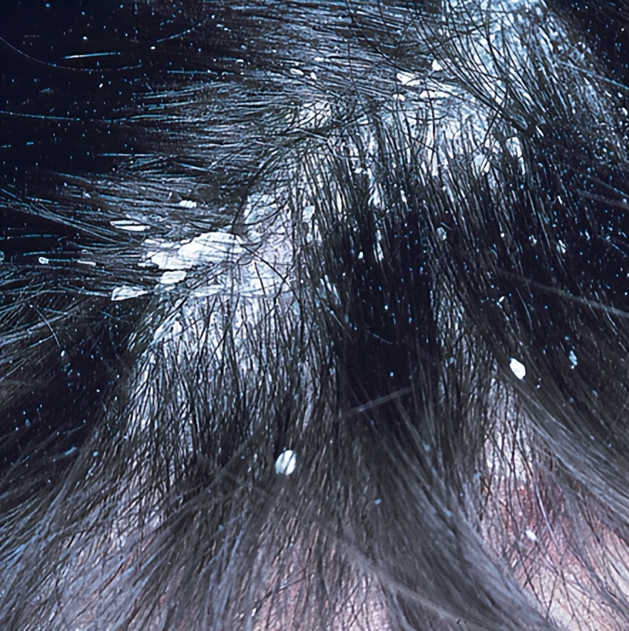 指甲抓头皮有白色的泥,头皮总能抠下来白泥