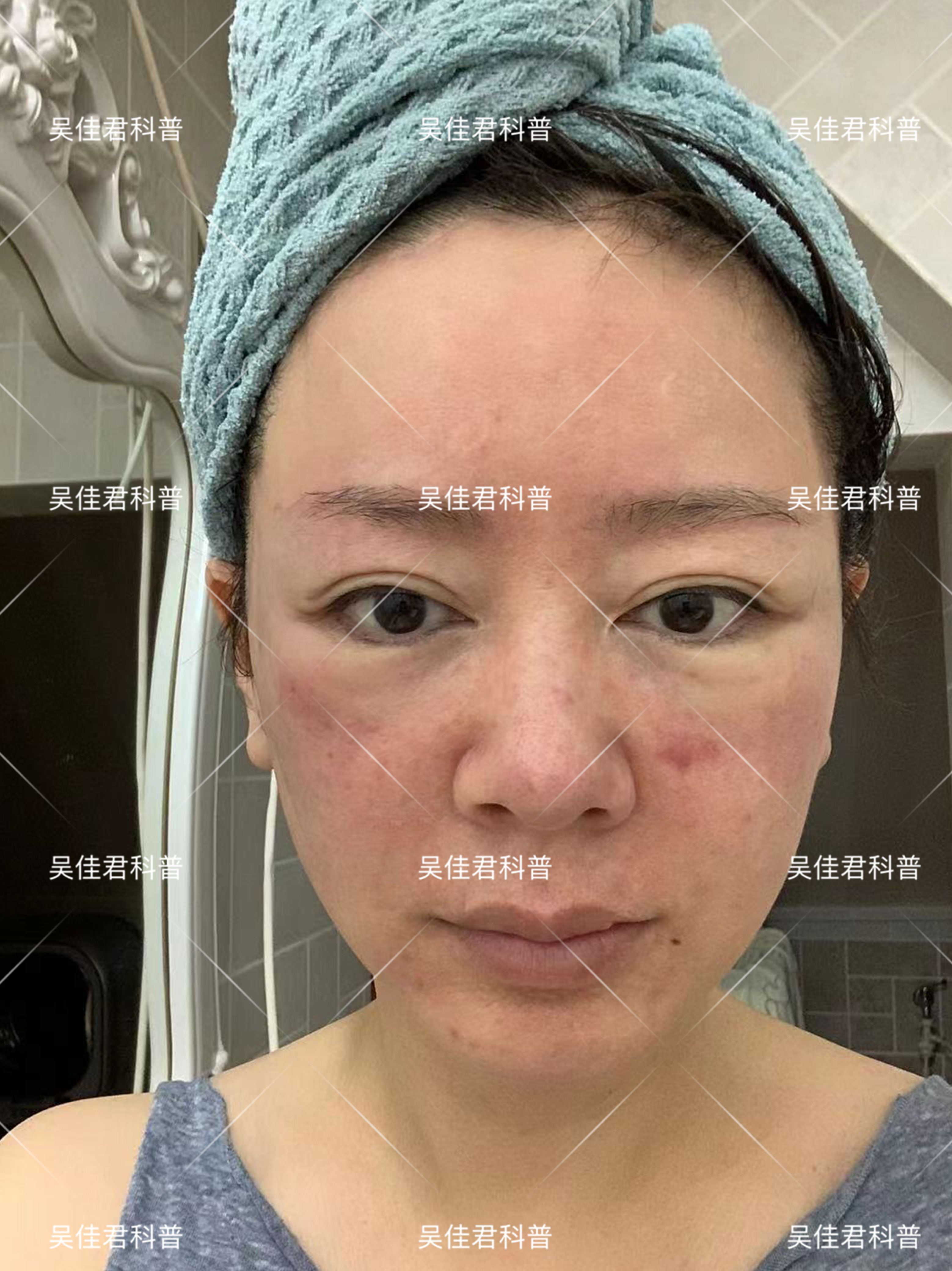 全脸皱纹拉皮手术对比,面部大拉皮恢复的真实感受