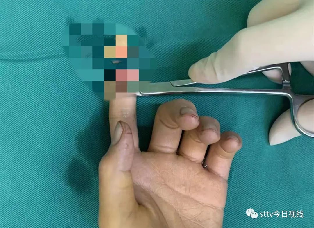 女子断指求助民警开道送医生,女子断指急需就医警笛开道