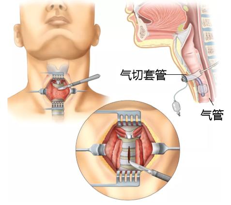 「市一专科」元宵佳节，气管镜室为何传来哭声？