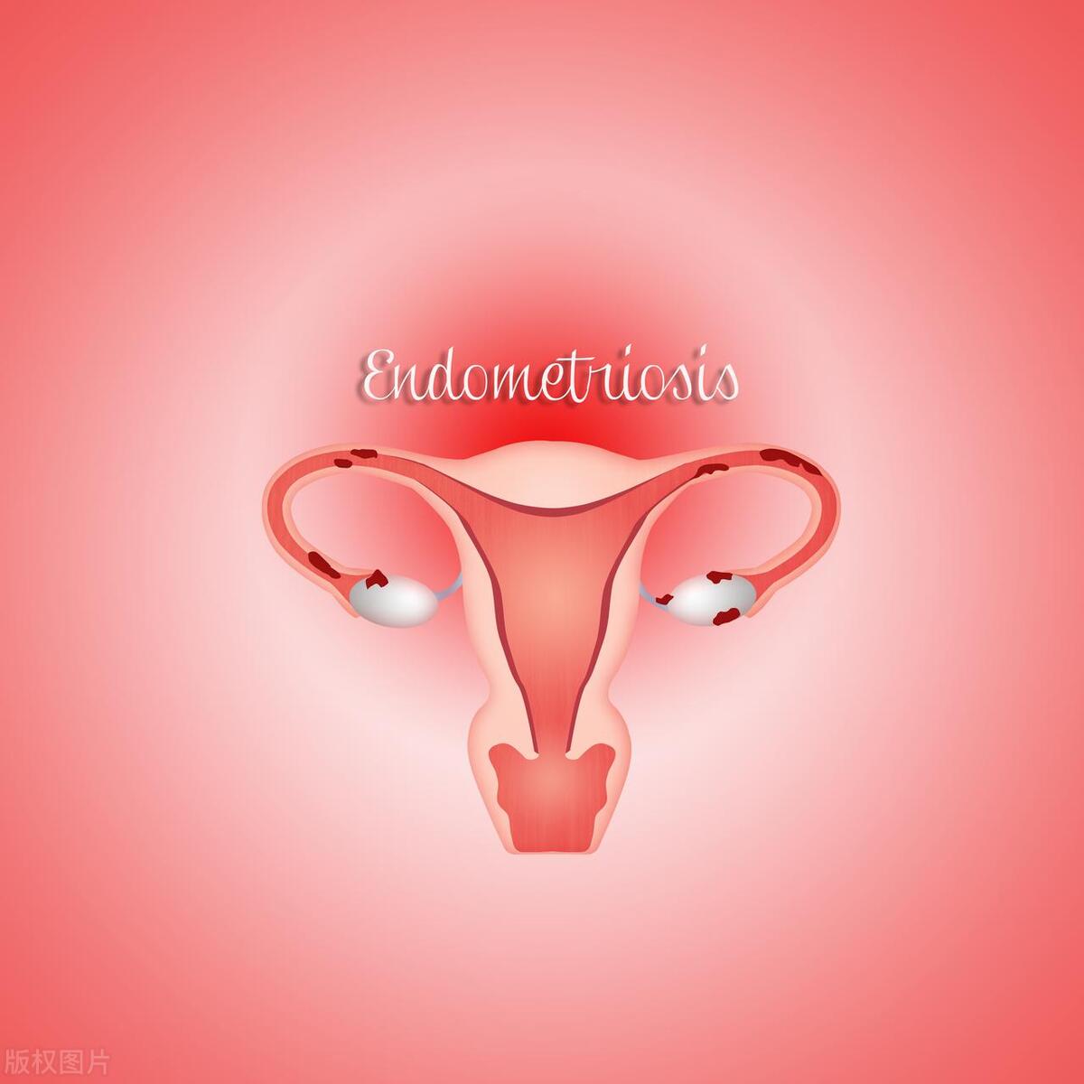 子宫内膜增厚13mm是子宫内膜癌吗,子宫内膜增厚是怎么回事严重吗