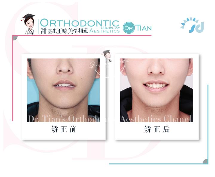 上下牙无法咬合是怎么回事,30岁牙齿咬合开颌还有必要矫正吗