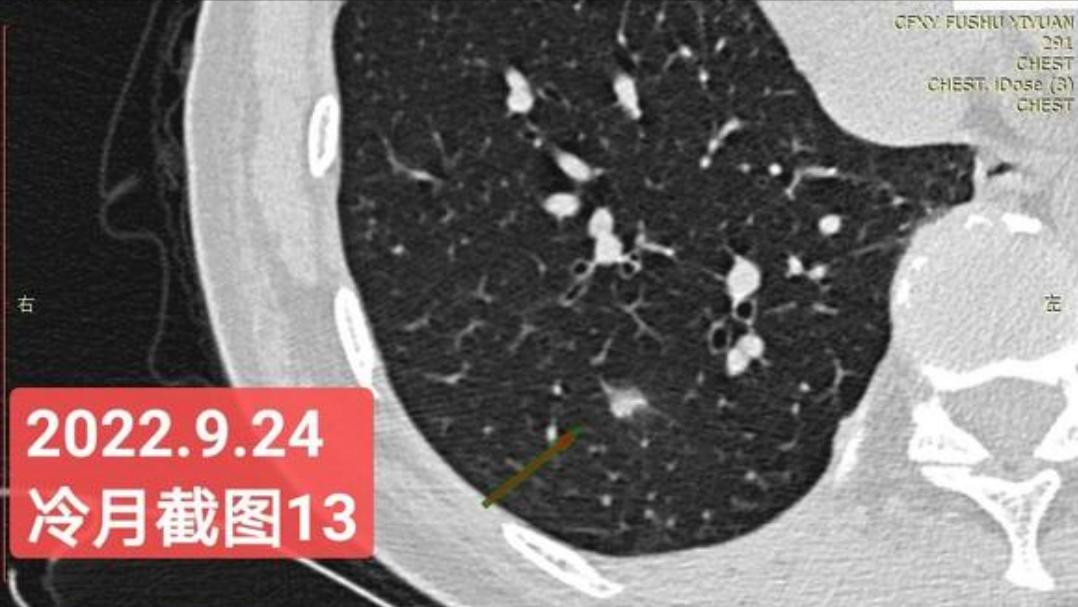 7mm肺结节恶性的怎么办,7mm实性肺结节危险程度