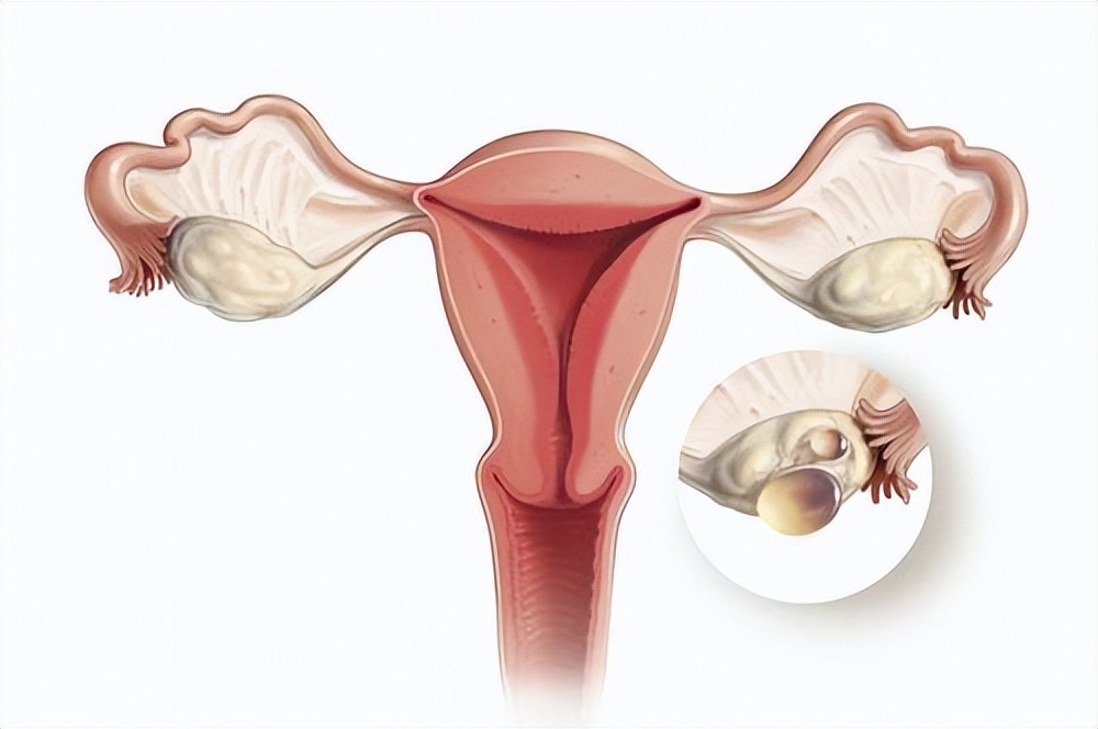 总跑厕所一般是什么病,一直小便是得了卵巢癌吗