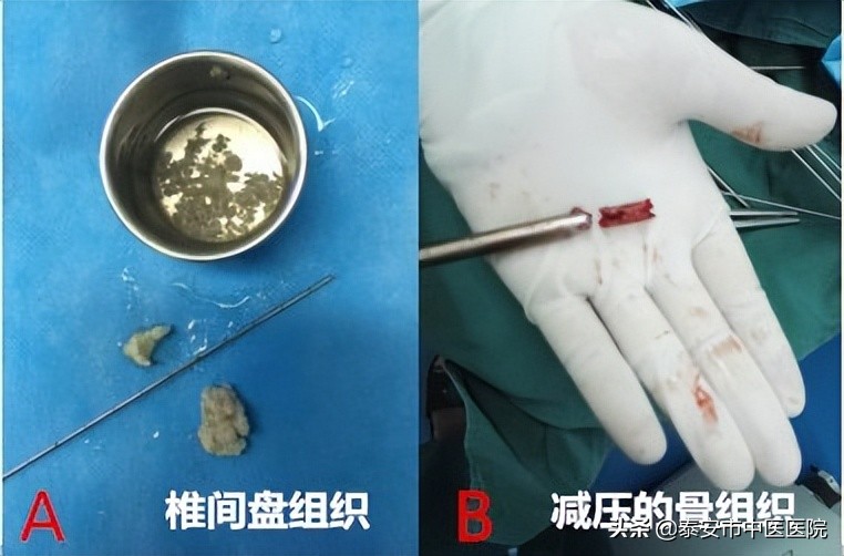 【中医特色，治骨疗伤】铁骨铮铮“脊”往开来——记*安泰**市中医医院（*安泰**市骨伤医院）脊柱外科