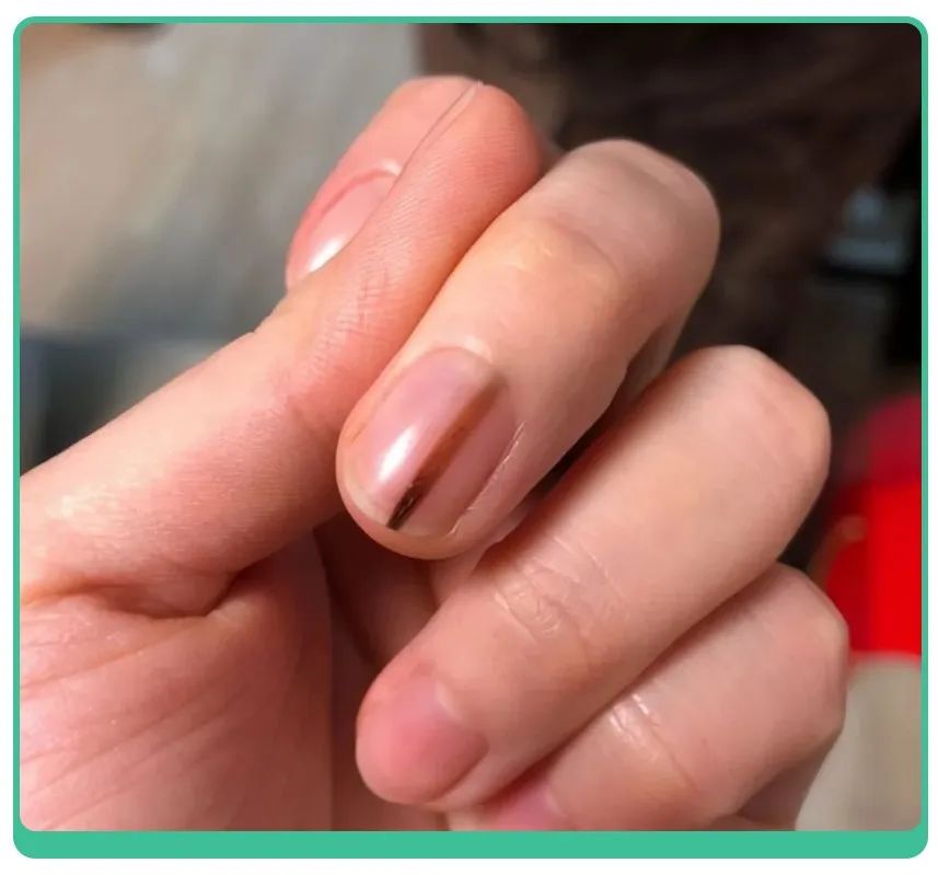 小孩指甲凹陷变黑有坑是什么原因,小孩指甲有白点和细纹是怎么回事