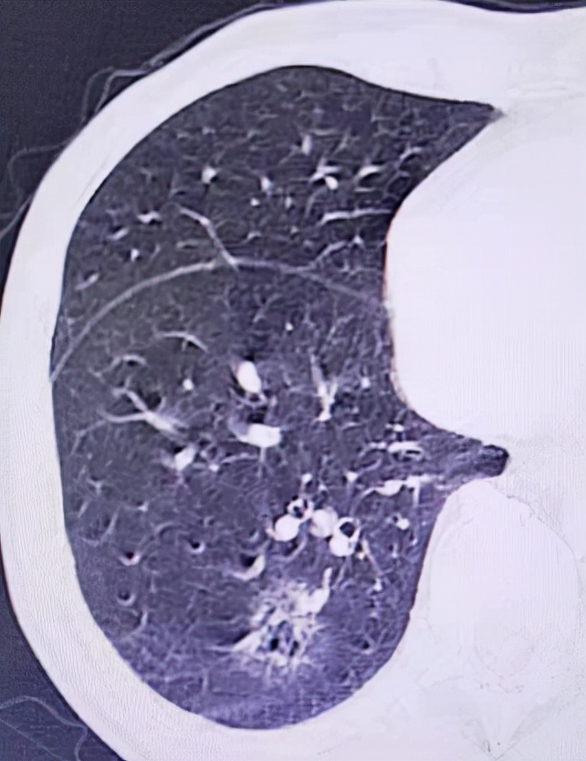 甲状腺结节消融术病例分析,肺部结节冷冻消融