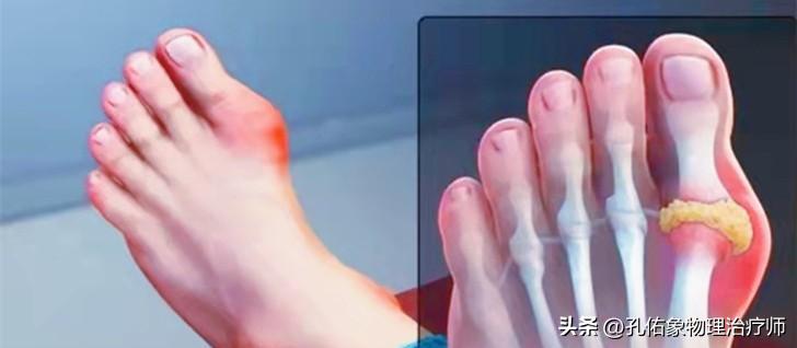 脚部信号透露健康问题,脚部出现这6种症状