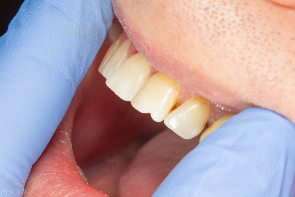 烂牙旁边有洞的正确治疗方法,为什么烂牙要钻洞