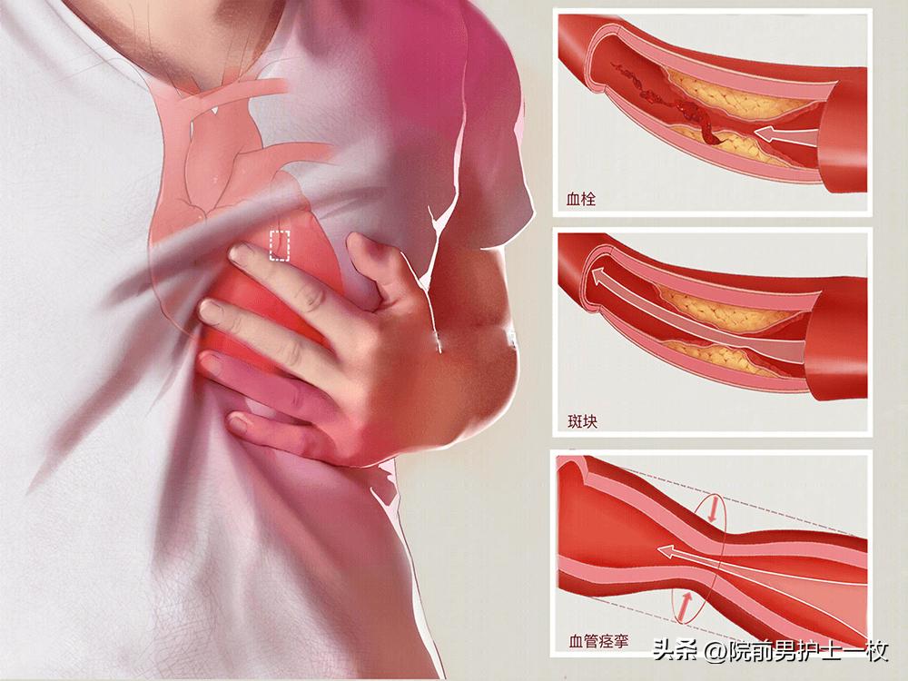 关于心绞痛护理措施的图片,冠心病心绞痛救治成功率