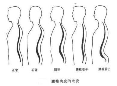 肋骨外翻哪些动作可以矫正,如何通过体态训练矫正肋骨外翻