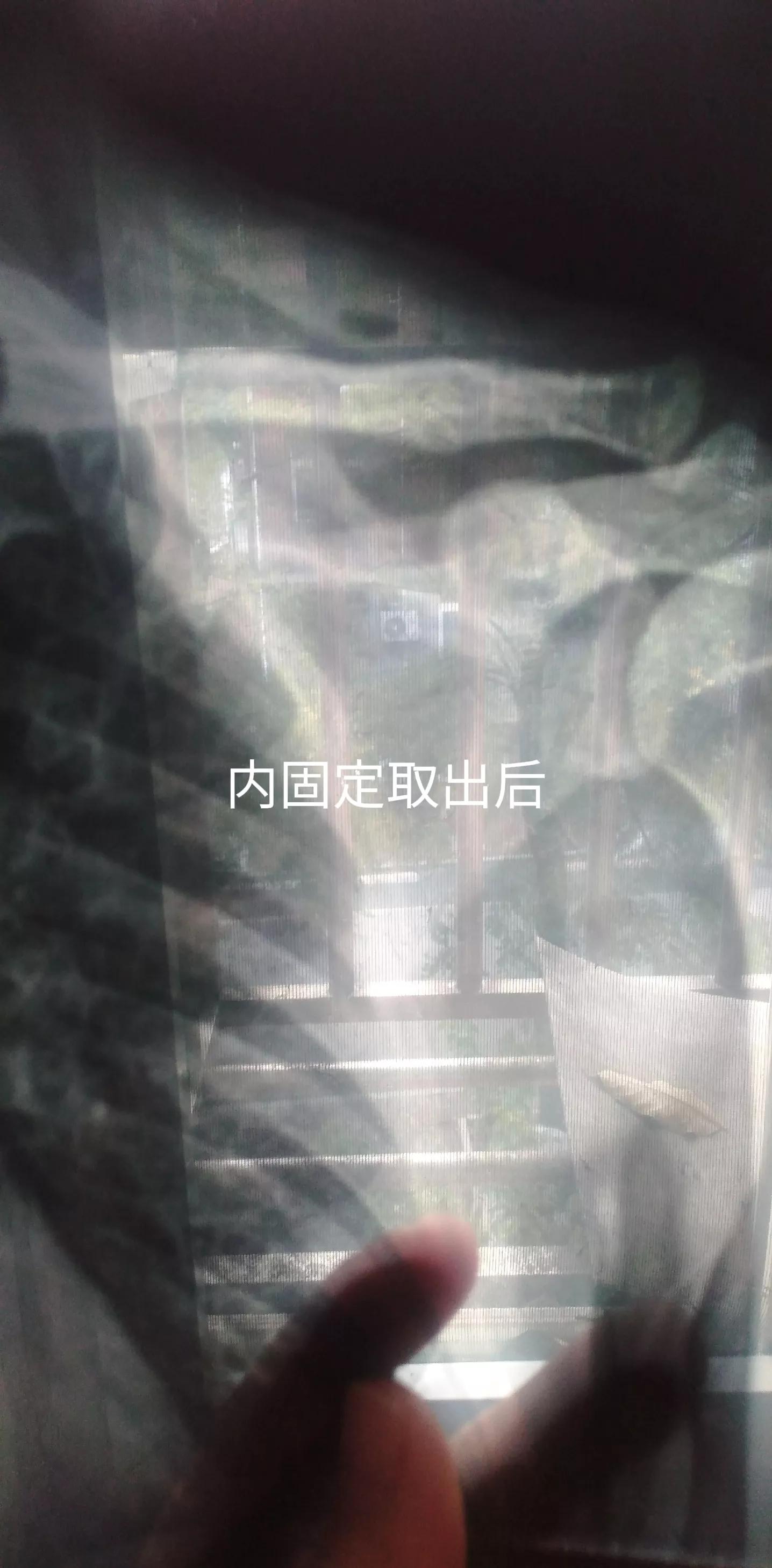 骑车摔倒肋骨骨折怎么办,骑车被摔成粉碎性骨折能痊愈吗