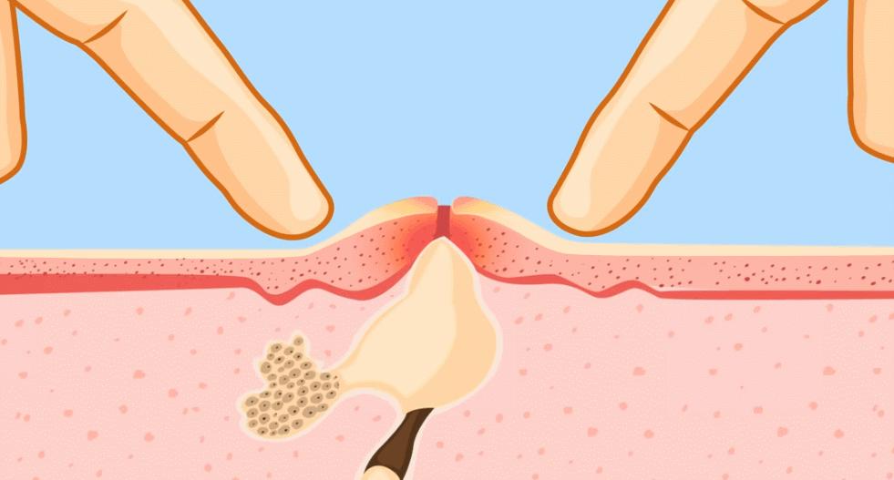 为什么说挤痘痘很危险,为什么说挤痘痘是往里面挤