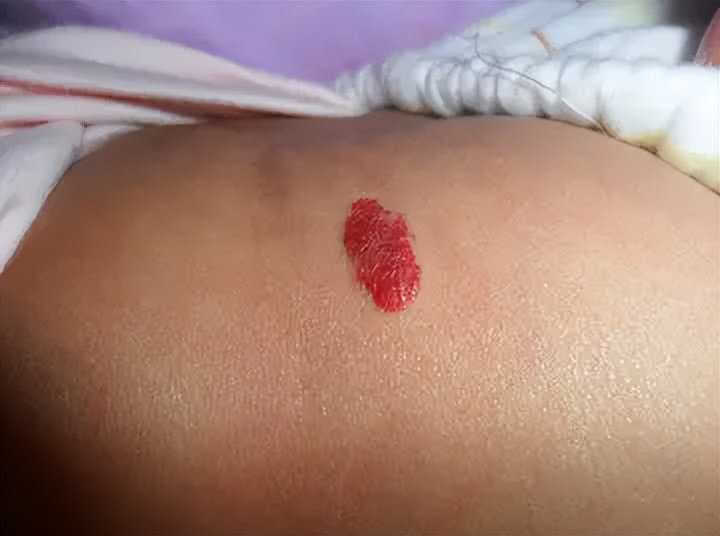 身上起小红点是什么原因造成的,身上的小红点是什么原因造成的