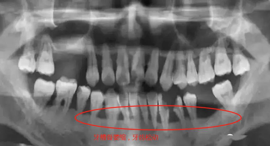 牙周炎大牙不拔的危害,牙周炎对脑血管的危害