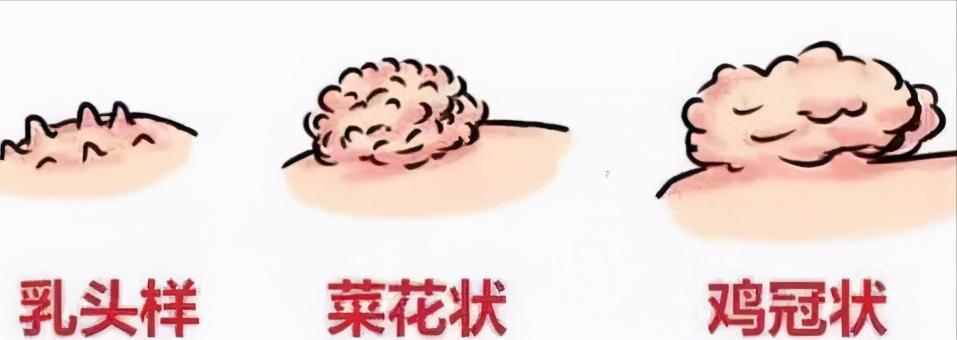 为爱鼓掌时,发现女友*体下**长疙瘩,是尖锐湿疣?