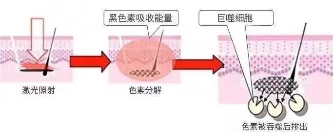 如何快速祛斑最有效方法,中药快速祛斑的有效方法