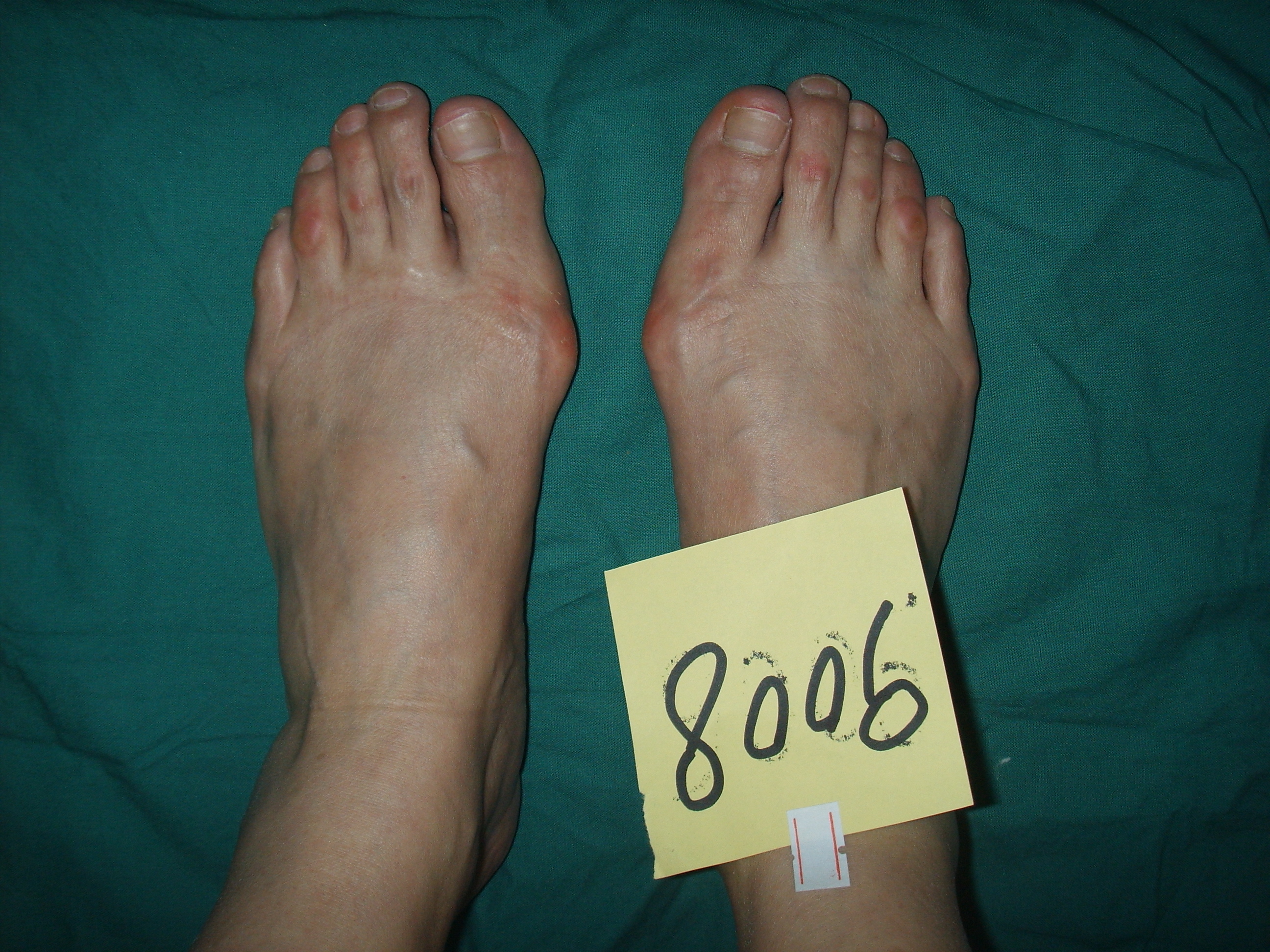 脚趾头关节骨头凸起,大脚趾拇外翻和正常脚对比