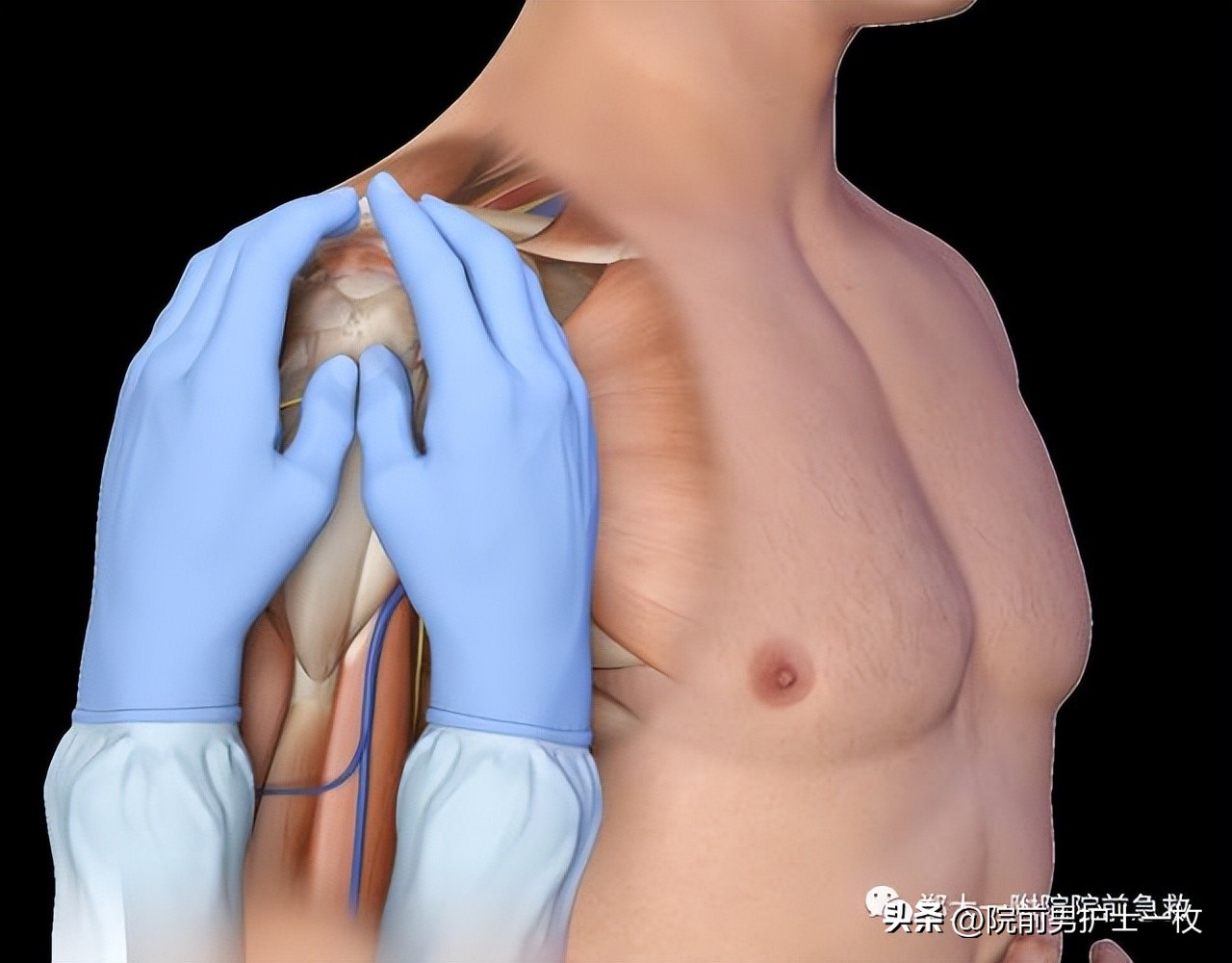 骨髓腔穿刺急救,骨髓腔穿刺适应症和禁忌症