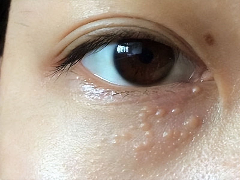 脖子和腋下的小肉粒可以揪掉吗,腋下的小肉粒能揪掉吗