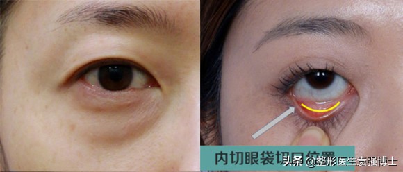 想彻底解决眼袋,想做除眼袋手术怎么和医生沟通