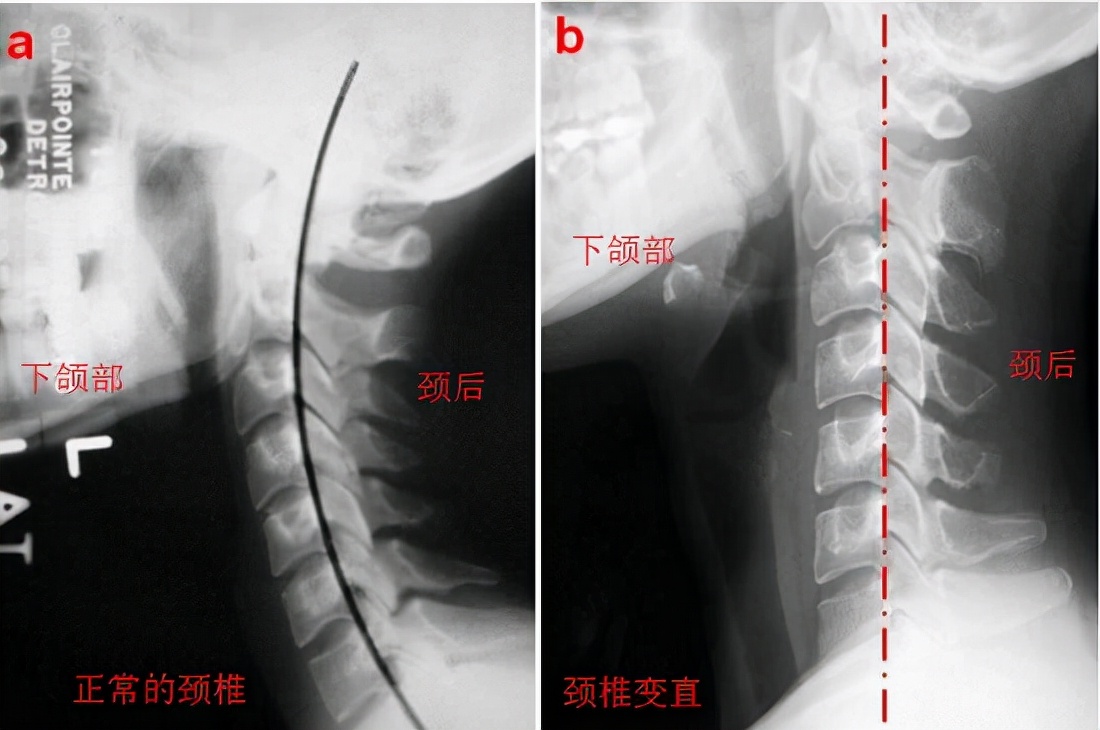 颈椎间盘突出的治疗方法有哪些,颈4567椎间盘向后突出能治愈吗